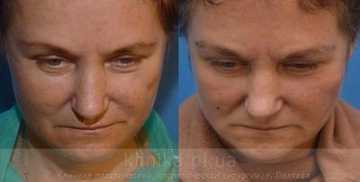 Face lipofilling before and after operation, photo 5