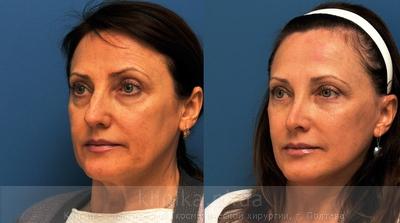 Facelifting before and after operation, photo 4