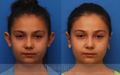 Otoplasty before and after operation, photo 6