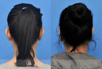 Пластика ушных раковин (отопластика) до и после операции, фото 2