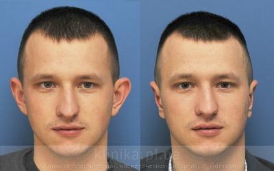 Otoplasty before and after operation, photo 2