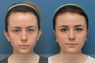 Пластика ушных раковин (отопластика) до и после операции, фото 9