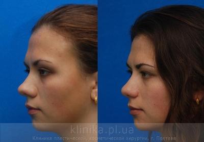 Correction of the tip and wings of the nose before and after operation, photo 4
