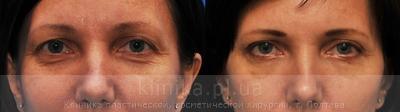 Blepharoplasty before and after operation, photo 9