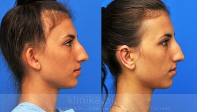 Otoplasty before and after operation, photo 3
