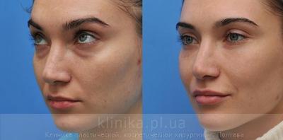 Blepharoplasty before and after operation, photo 6