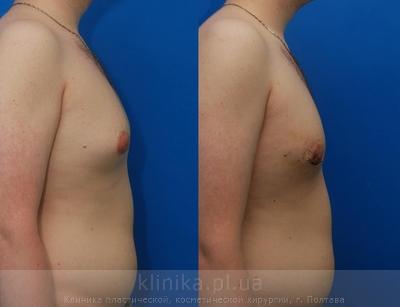 Treatment of gynecomastia before and after operation, photo 9