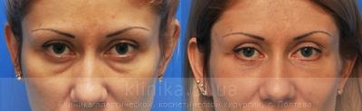 Blepharoplasty before and after operation, photo 4