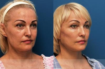 Facelifting before and after operation, photo 7