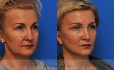 Facelifting before and after operation, photo 8