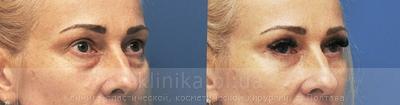 Blepharoplasty before and after operation, photo 9