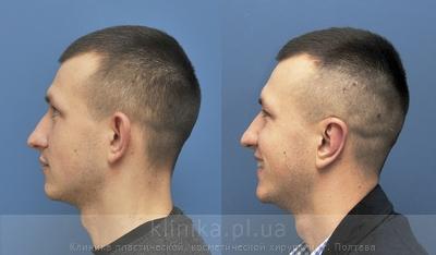 Пластика ушных раковин (отопластика) до и после операции, фото 3