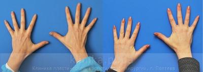 Ліпофілінг кистей рук до і після операції, фото 1