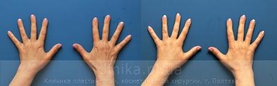 Lipofilling of the hands before and after operation, photo 5