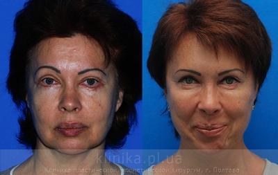 Facelifting before and after operation, photo 9