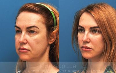 Facelifting before and after operation, photo 2