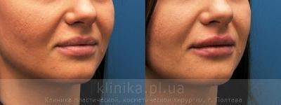 Contour correction before and after operation, photo 4