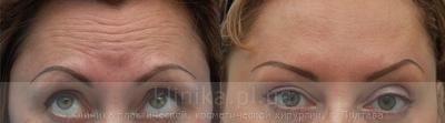 The correction of mimic wrinkles. before and after operation, photo 4