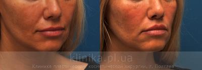 Surgical correction of the shape and volume of the lips (chalinoplasty) before and after operation, photo 7
