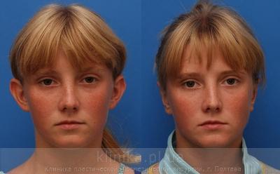 Пластика ушных раковин (отопластика) до и после операции, фото 6