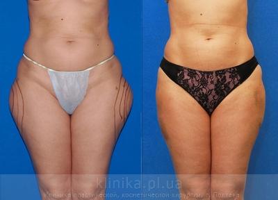 Liposuction before and after operation, photo 4