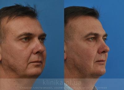 Сorrection volume and shape of the chin before and after operation, photo 4