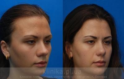 Correction of the tip and wings of the nose before and after operation, photo 3