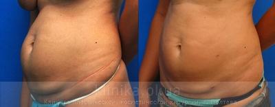 Liposuction before and after operation, photo 3