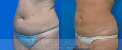 Liposuction before and after operation, photo 2
