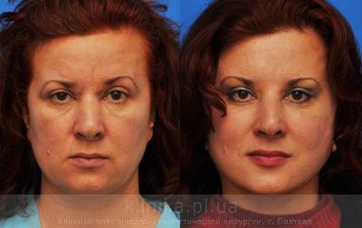 The plastics of the forehead (the front plastics) before and after operation, photo 5