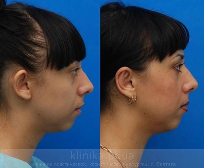 Otoplasty before and after operation, photo 9