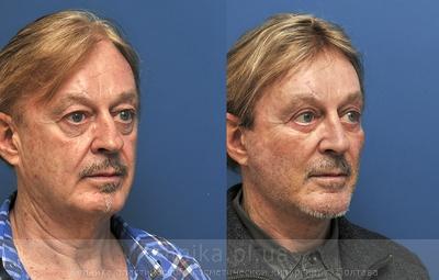 Фейслифтинг до и после операции, фото 8
