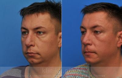 Сorrection volume and shape of the chin before and after operation, photo 3