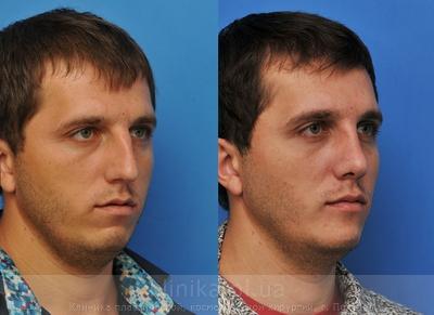 Сorrection volume and shape of the chin before and after operation, photo 2