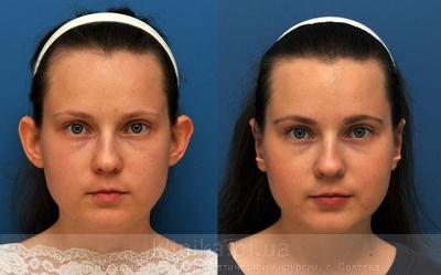 Otoplasty image 4135 Otoplasty image 4135