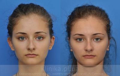 Otoplasty before and after operation, photo 1