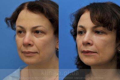Ліпофілінг обличчя до і після операції, фото 4