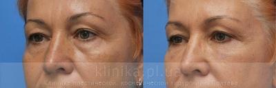 Ліпофілінг обличчя до і після операції, фото 3