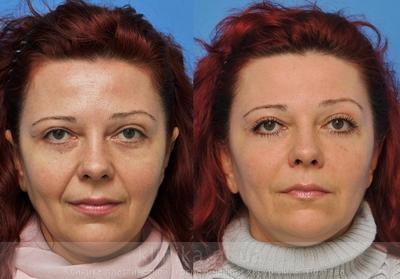 Face lipofilling before and after operation, photo 9