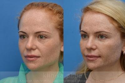 Face lipofilling before and after operation, photo 2