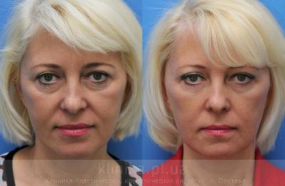 Face lipofilling before and after operation, photo 5