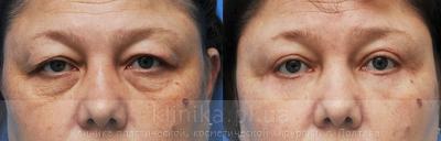 Blepharoplasty before and after operation, photo 5