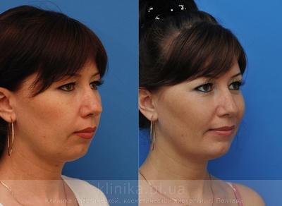 Сorrection volume and shape of the chin before and after operation, photo 7
