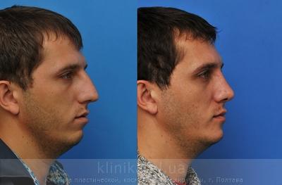 Сorrection volume and shape of the chin before and after operation, photo 3