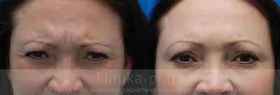 The correction of mimic wrinkles. before and after operation, photo 1