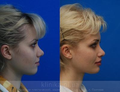 Сorrection volume and shape of the chin before and after operation, photo 1