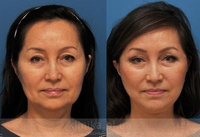 Facelifting before and after operation, photo 6