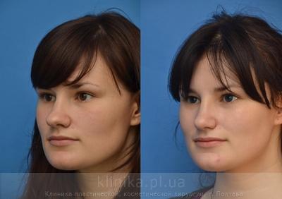 Correction of the tip and wings of the nose before and after operation, photo 1