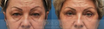 Blepharoplasty before and after operation, photo 8