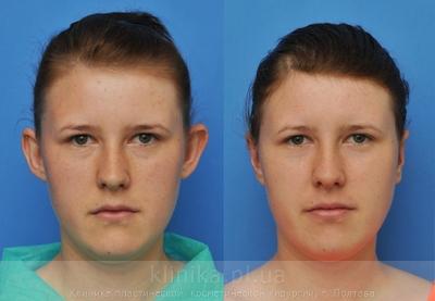 Otoplasty before and after operation, photo 7
